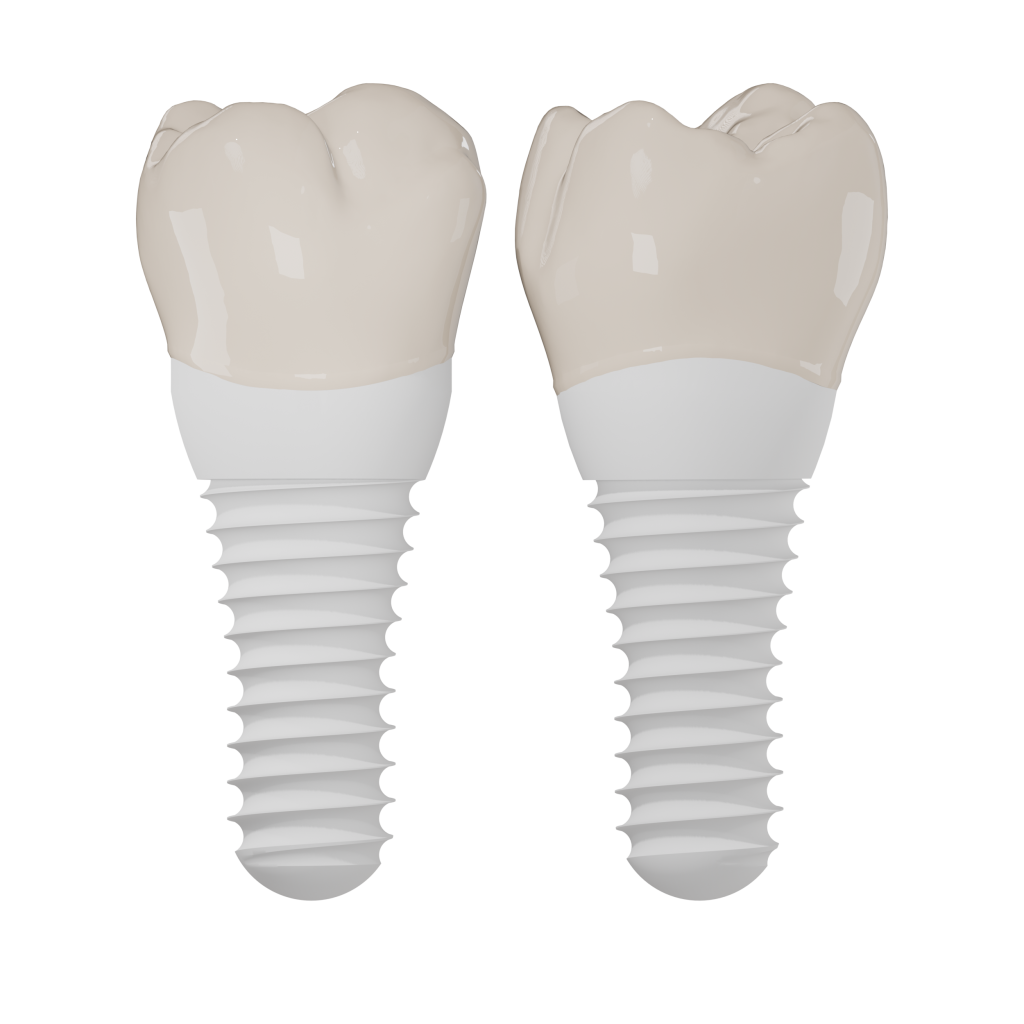 Implant dentar ceramic din zirconiu cu coroana finală montată — rezultat estetic complet