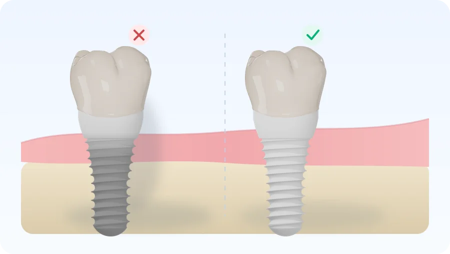 Comparație estetică implant titan vs zirconiu — umbra metalică la gingie vs alb integral