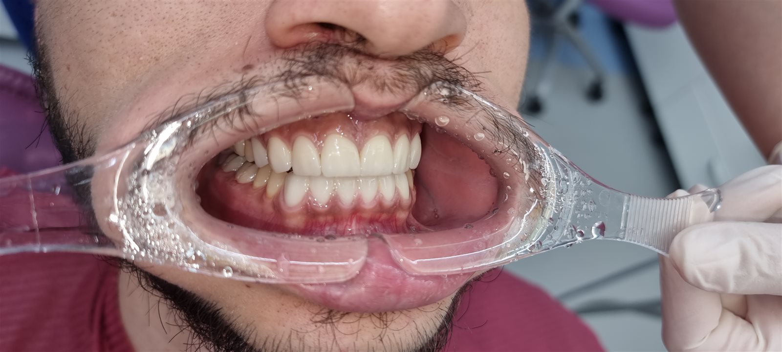 Rezultat final implant dentar din zirconiu — dinți albi și estetici